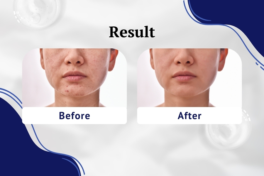 Kết quả sử dụng Arbutin kết hợp Niacinamide trong chăm sóc da