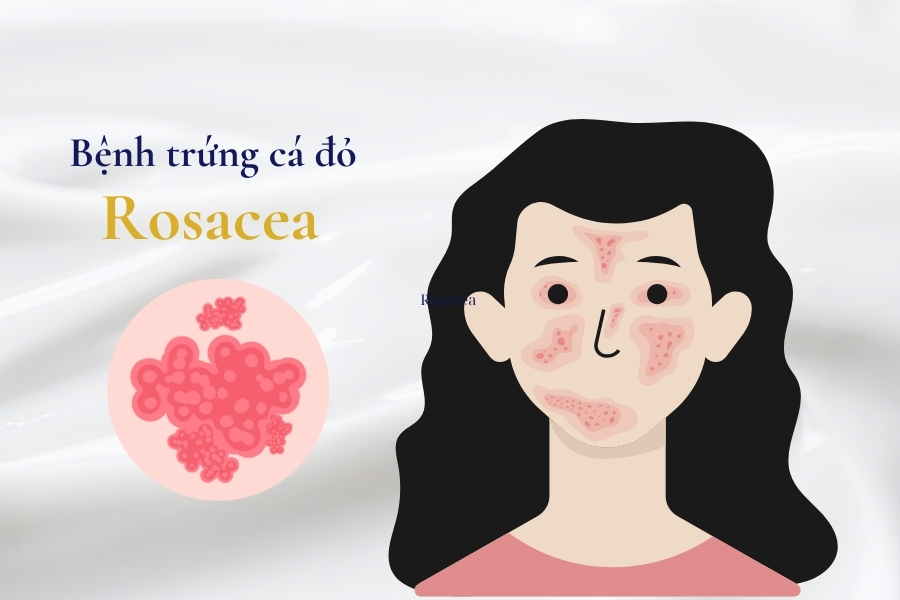 Dùng Azelaic Acid giảm viêm, điều trị Rosacea Dùng Azelaic Acid giảm viêm, điều trị Rosacea