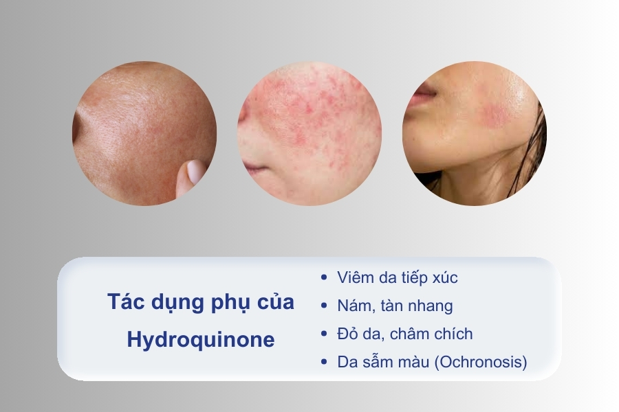 Hydroquinone có hại không? Có những tác dụng phụ nào?