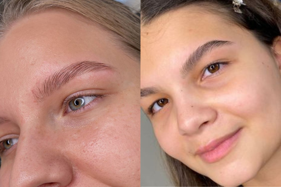 Cơ địa nhạy cảm thường có thời gian phục hồi lâu hơn sau khi xóa xăm chân mày