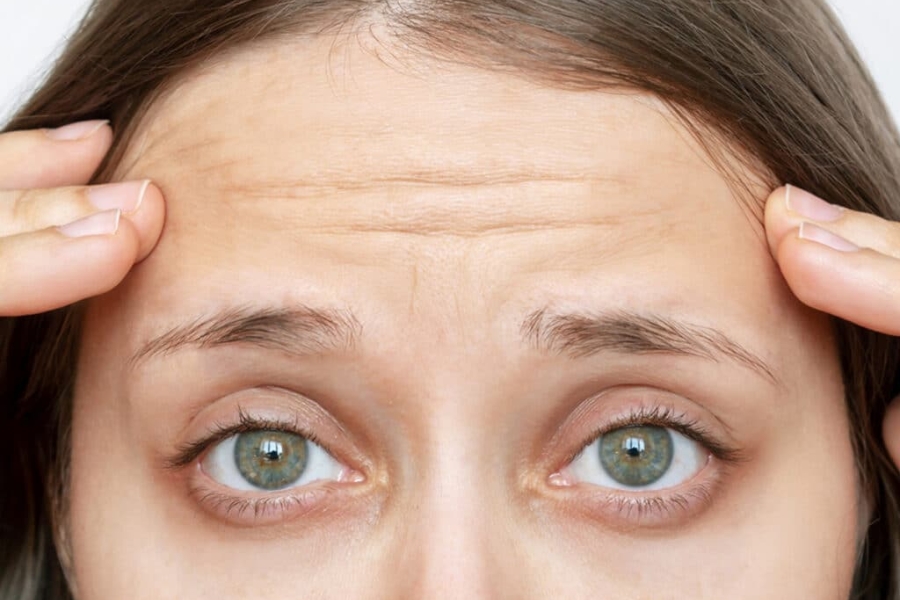 Nâng cung chân mày xóa mờ nếp nhăn, giảm dấu hiệu lão hóa Nâng cung chân mày xóa mờ nếp nhăn, giảm dấu hiệu lão hóa