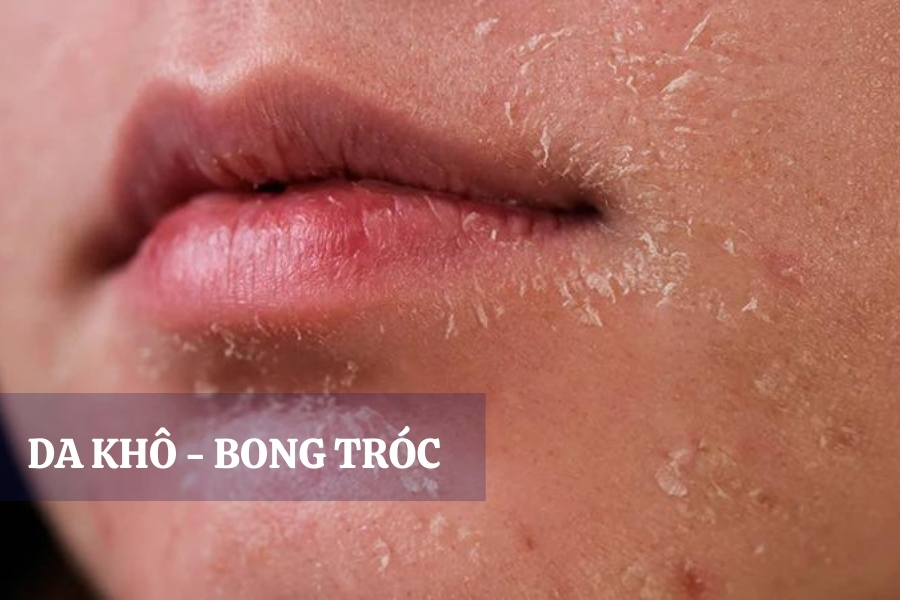 Da bị khô và bong tróc khi mới sử dụng Azelaic Acid trị mụn Da bị khô và bong tróc khi mới sử dụng Azelaic Acid trị mụn