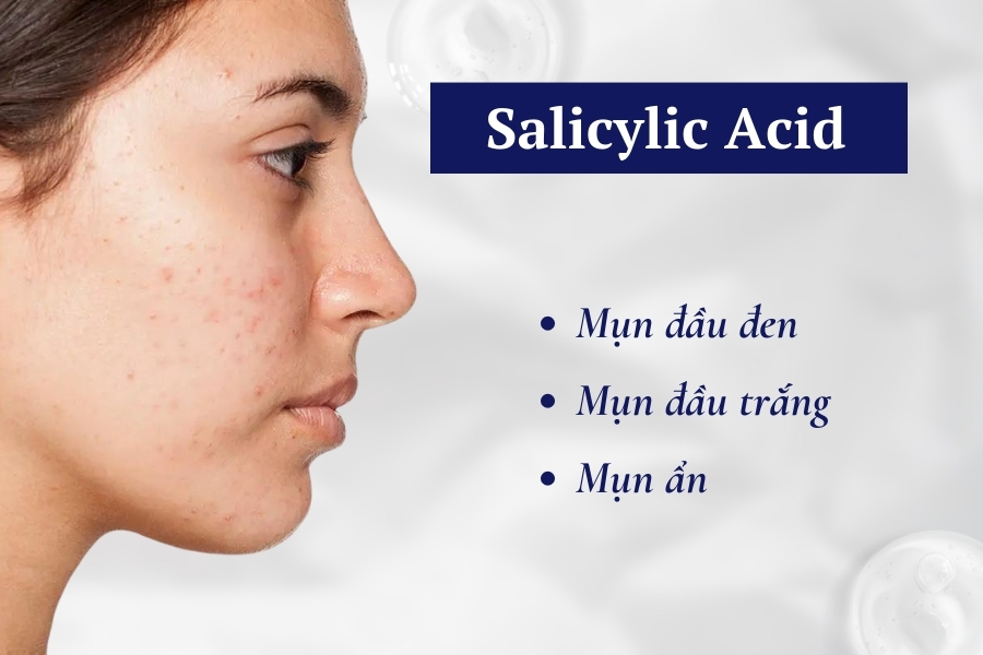 Salicylic Acid có công dụng hỗ trợ điều trị mụn Salicylic Acid có công dụng hỗ trợ điều trị mụn