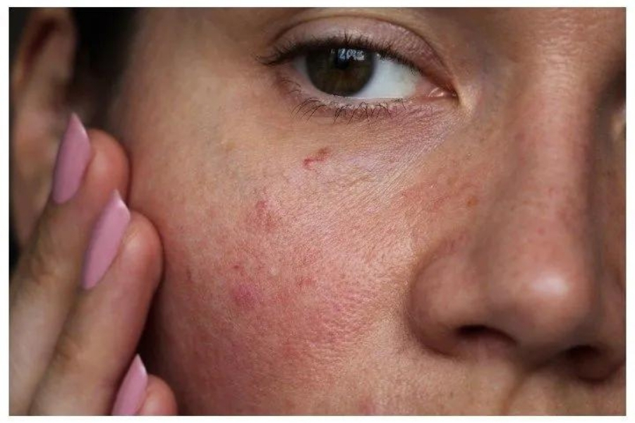 Azelaic Acid là gì? Có tác dụng gì? Cách dùng như thế nào? 6 Bôi Azelaic Acid bị ngứa thì phải làm sao?