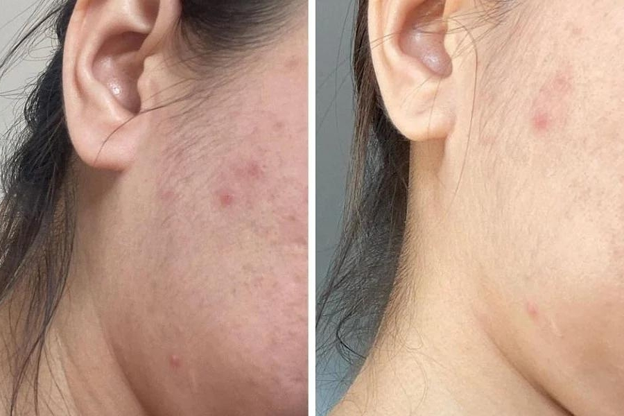 Tranexamic acid có thể hỗ trợ điều trị mụn trứng cá, tăng sắc tố sau viêm