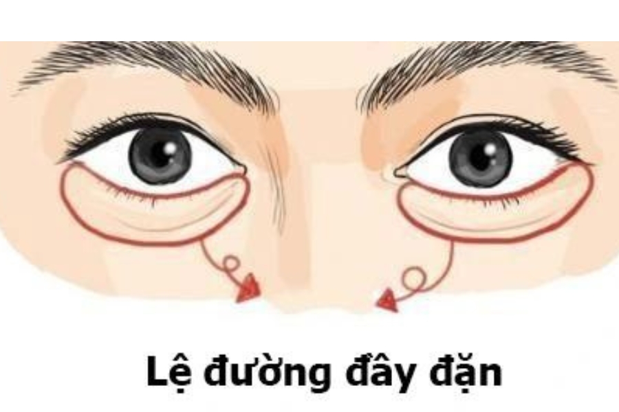 Lệ đường đầy đặn thì hậu vận của con cái hưởng đầy phúc lộc Lệ đường đầy đặn thì hậu vận của con cái hưởng đầy phúc lộc