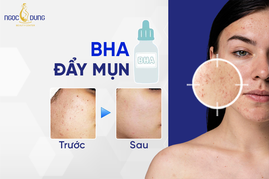 Dùng BHA đẩy mụn trong bao lâu? Phân biệt purging và break out