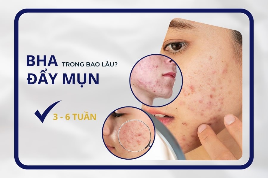 Dùng BHA đẩy mụn trong bao lâu?