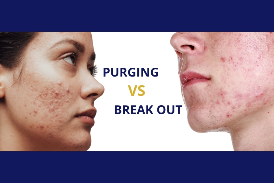 Phân biệt purging và break out như thế nào?