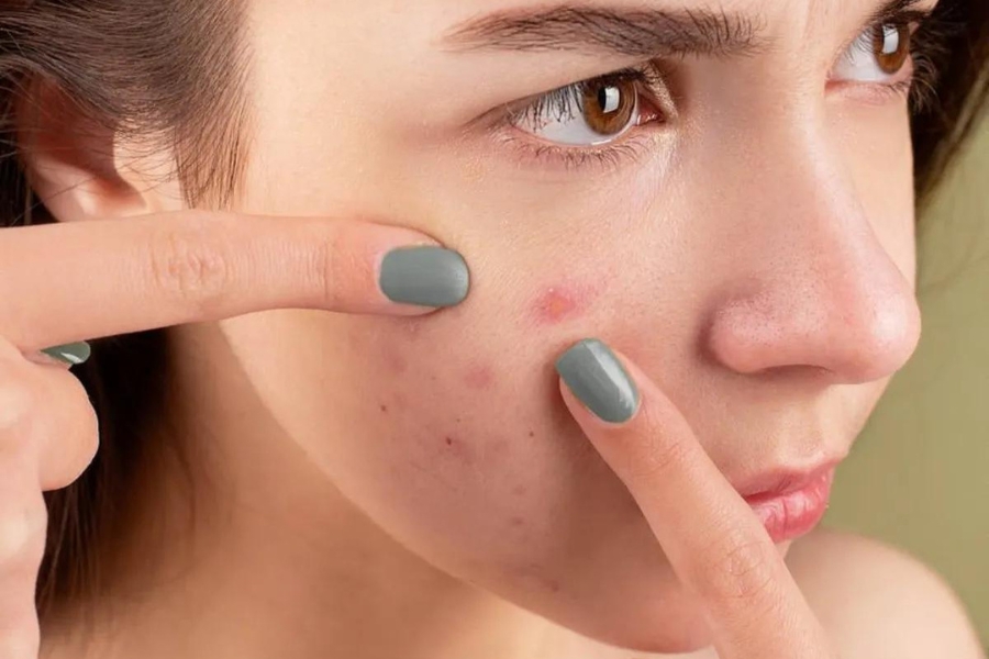 Bị mụn có thể xông mặt và nên xông 1-2 lần/tuần Bị mụn có thể xông mặt và nên xông 1-2 lần/tuần