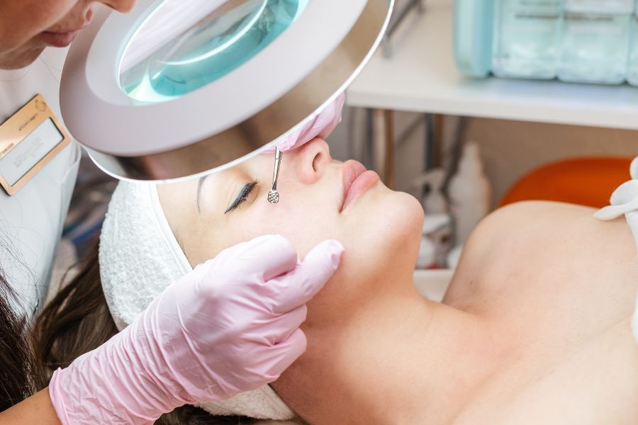 Điều trị mụn ở thái dương bằng cách lấy cồi mụn tại spa chuyên nghiệp