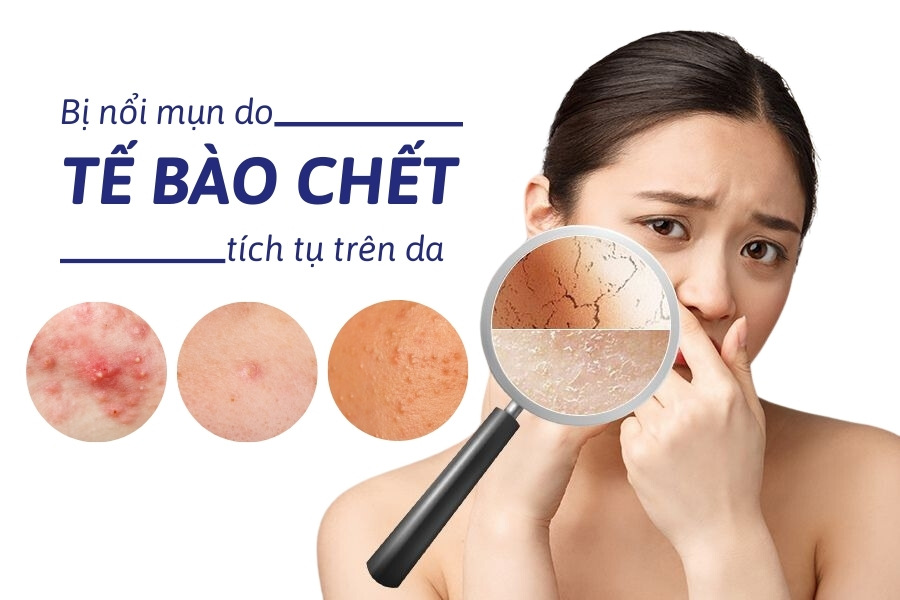 Tế bào chết ở trên da quá dày sẽ gây tắc nghẽn lỗ chân lông và hình thành mụn