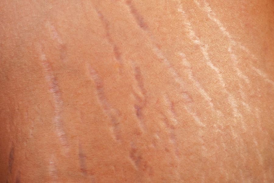 Rạn da đỏ dễ xuất hiện trong giai đoạn dậy thì