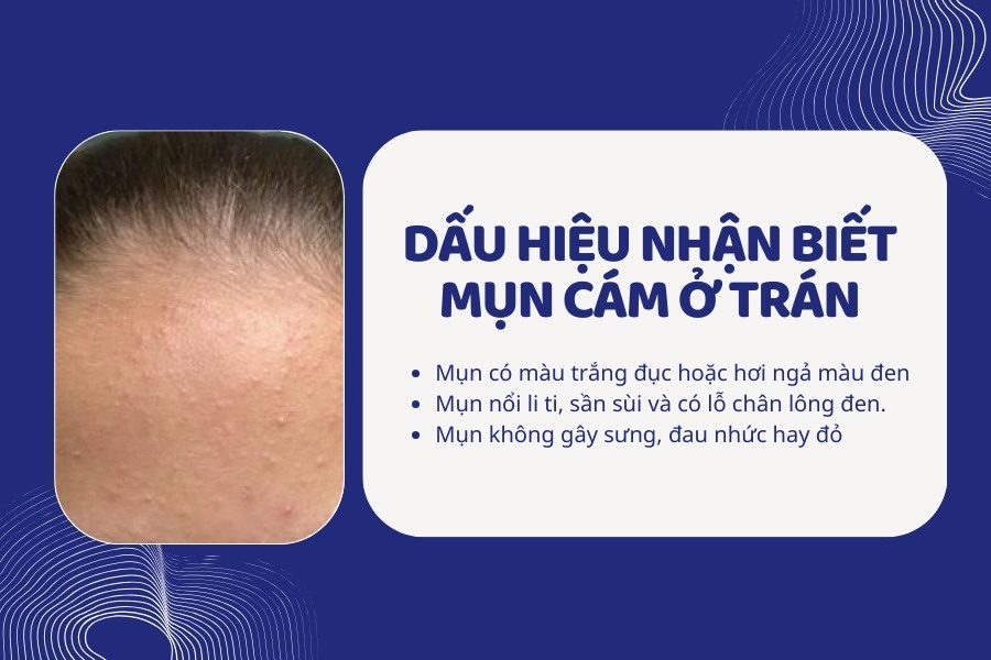 Khi sờ vào mụn cám sẽ cảm thấy sần sùi Khi sờ vào mụn cám sẽ cảm thấy sần sùi