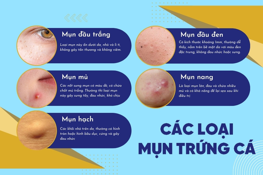 Các loại mụn trứng cá thường xuất hiện trên da Các loại mụn trứng cá thường xuất hiện trên da
