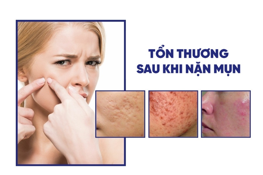 Nặn mụn trứng cá có thể để lại những vết thâm sẹo không mong muốn trên da