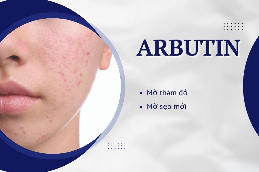 Có thể dùng Arbutin trong phác đồ trị mụn để giảm các vết thâm và sẹo