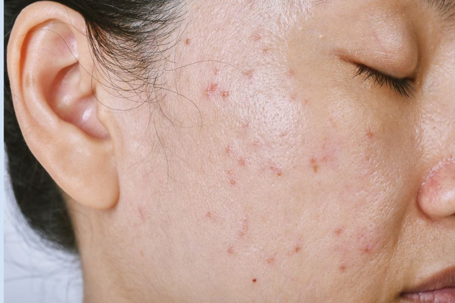 Tuyến bã nhờn sản xuất nhiều dầu thừa gây ra mụn Tuyến bã nhờn sản xuất nhiều dầu thừa gây ra mụn