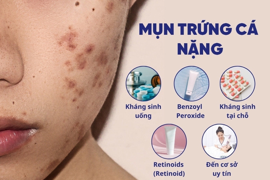 Mụn trứng cá viêm, mụn nặng nên kết hợp dùng thuốc kháng sinh và thuốc bôi ngoài Mụn trứng cá viêm, mụn nặng nên kết hợp dùng thuốc kháng sinh và thuốc bôi ngoài