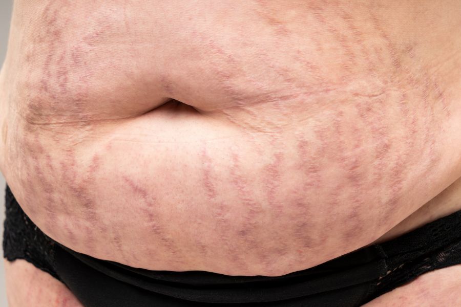 Bị rạn da đỏ do tăng cân 