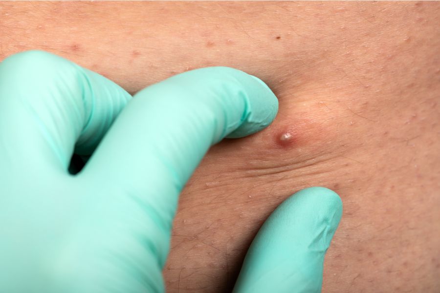 Hình ảnh viêm nang lông vùng kín ở mức độ nhẹ