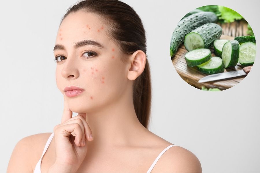 Mặt nạ dưa chuột giúp làm dịu các nốt mụn mang lại làn da mịn màng hơn