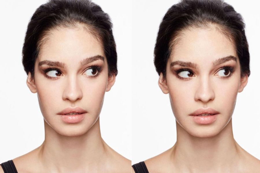 Lông mày bên cao bên thấp có thể hình thành do bẩm sinh Lông mày bên cao bên thấp có thể hình thành do bẩm sinh