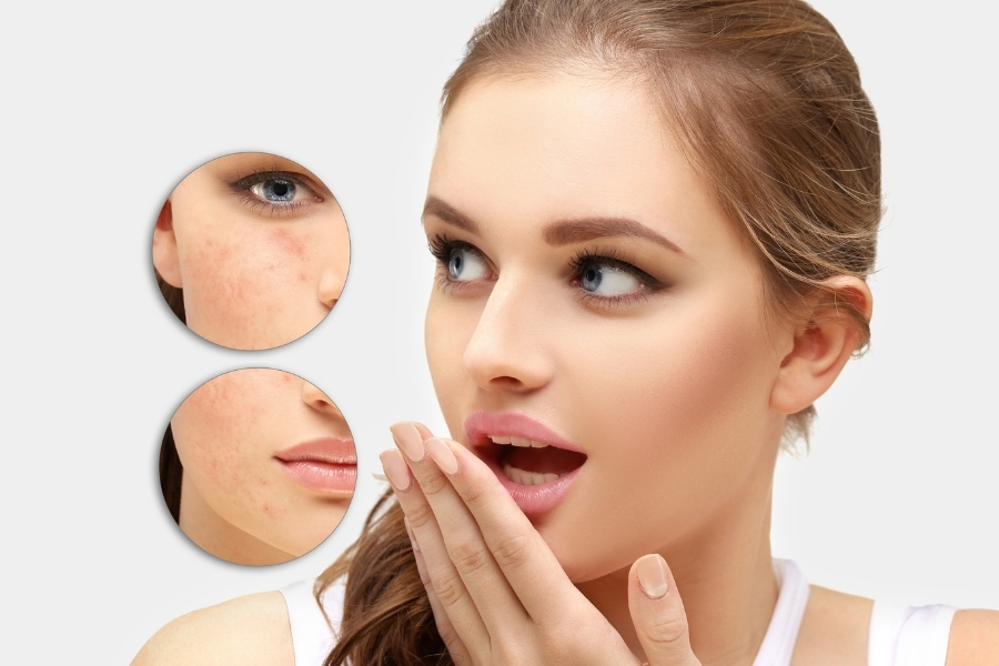 Trị thâm mụn bằng axit kojic Trị thâm mụn bằng axit kojic