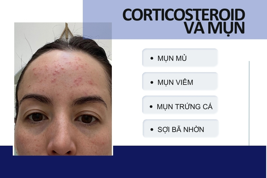Corticosteroid có thể cản trở quá trình di chuyển của bạch cầu để giảm viêm ở các nốt mụn Corticosteroid có thể cản trở quá trình di chuyển của bạch cầu để giảm viêm ở các nốt mụn