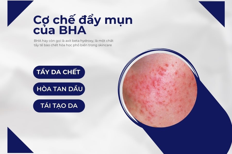 Tìm hiểu cơ chế đẩy mụn của BHA