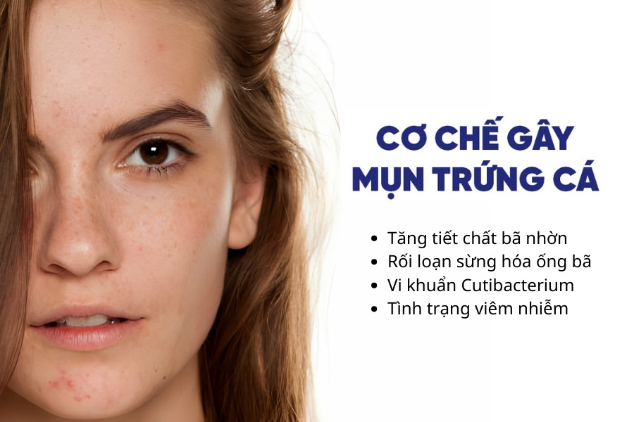 Cơ chế gây ra mụn trứng cá được xác định dựa trên bốn yếu tố quan trọng Cơ chế gây ra mụn trứng cá được xác định dựa trên bốn yếu tố quan trọng