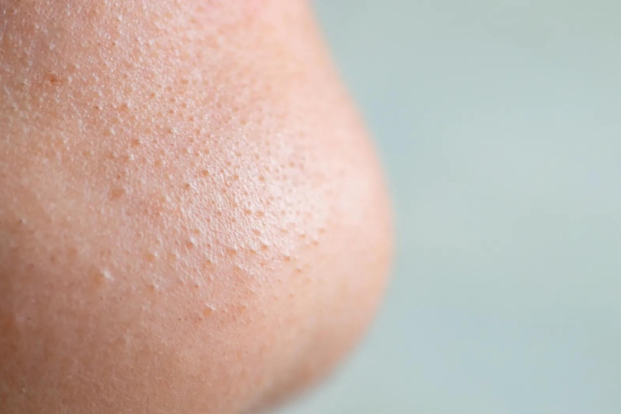 Lỗ chân lông bị bít tắc khi bôi kem chống nắng ban đêm Lỗ chân lông bị bít tắc khi bôi kem chống nắng ban đêm