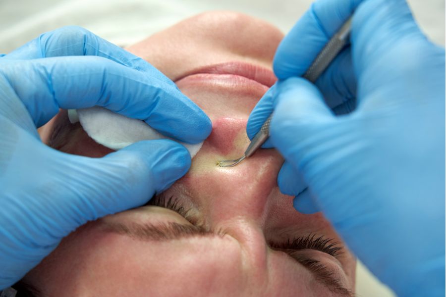 Nặn mụn tại spa có thể giúp tránh được các rủi ro không mong muốn