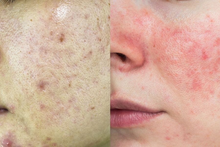 Da mụn có nên dùng BHA không?