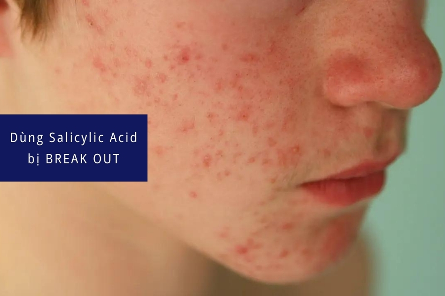 Tác dụng phụ của Salicylic Acid là gì? Tác dụng phụ của Salicylic Acid là gì?