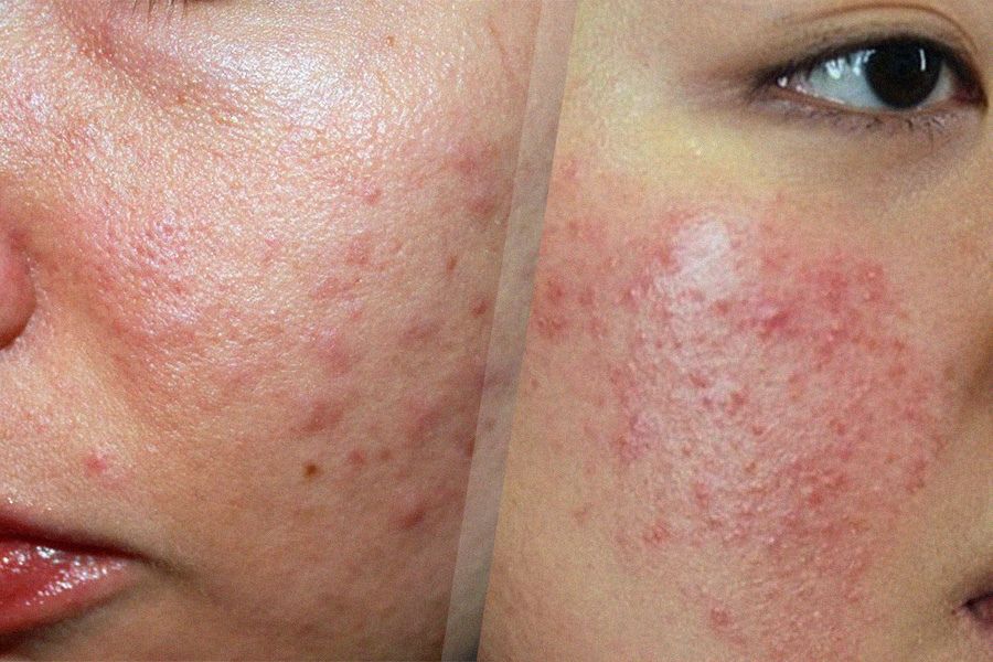 Dấu hiệu da bị kích ứng mỹ phẩm và các cách giảm kích ứng da 2 Dấu hiệu da kích ứng đỏ, viêm nhiễm, mụn mủ và sưng tấy