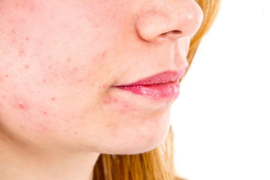 Mặt bị kích ứng do hóa chất, hương liệu, gây mẩn đỏ và châm chích rất khó chịu Mặt bị kích ứng do hóa chất, hương liệu