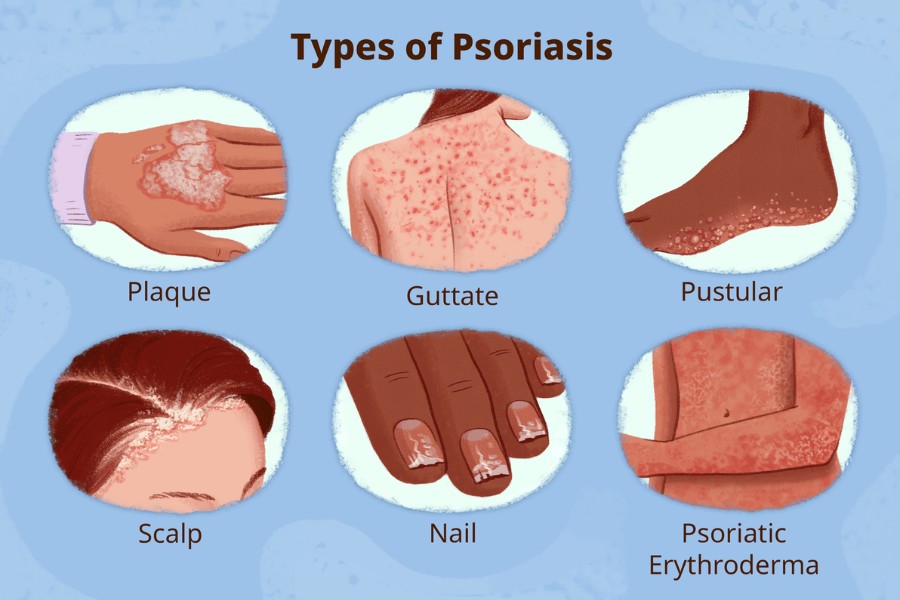 Vảy nến thường gây ra các vấn đề bong tróc, đóng vảy trắng trên da Vảy nến thường gây ra các vấn đề bong tróc, đóng vảy trắng trên da