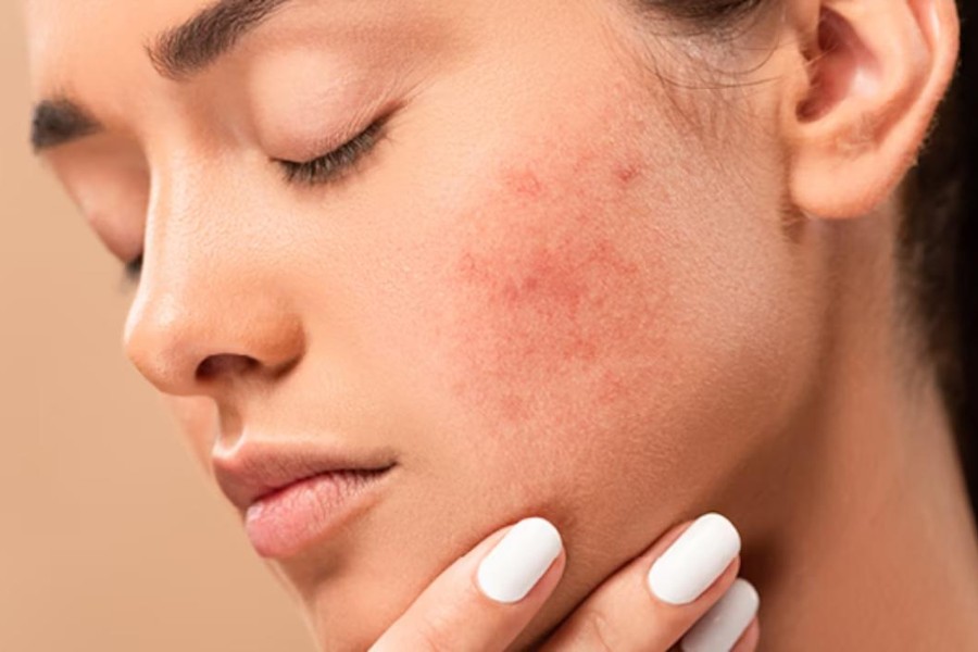 Da mặt đỏ và xuất hiện các nốt sần, đốm nhỏ và ngứa là một trong những dấu hiệu phổ biến cho thấy da mặt bị dị ứng nổi sần ngứa Da mặt đỏ và xuất hiện các nốt sần, đốm nhỏ và ngứa