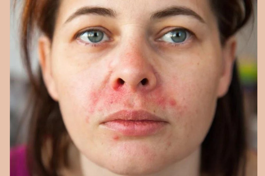 Viêm da tiết bã nhờn trên mặt gây ra các cơn ngứa, nóng rát và mẩn đỏ do hoạt động quá mức của tuyến bã nhờn. Viêm da tiết bã nhờn trên mặt gây ra các cơn ngứa, nóng rát và mẩn đỏ do hoạt động quá mức của tuyến bã nhờn.