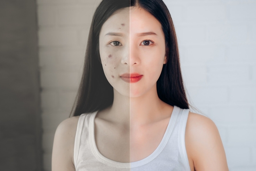 Rau má có khả năng hỗ trợ đào thải độc tố trên da và ngăn chặn các nguy cơ hình thành mụn mặt nạ rau má giúp ngăn ngừa hình thành mụn