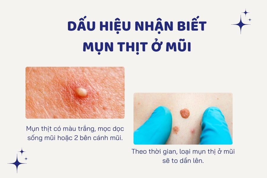 Mụn thịt ở mũi là những mốt mụn màu trắng, nổi cộm trên da và to dần theo thời gian https://v3.thammyvienngocdung.com/mun-thit/