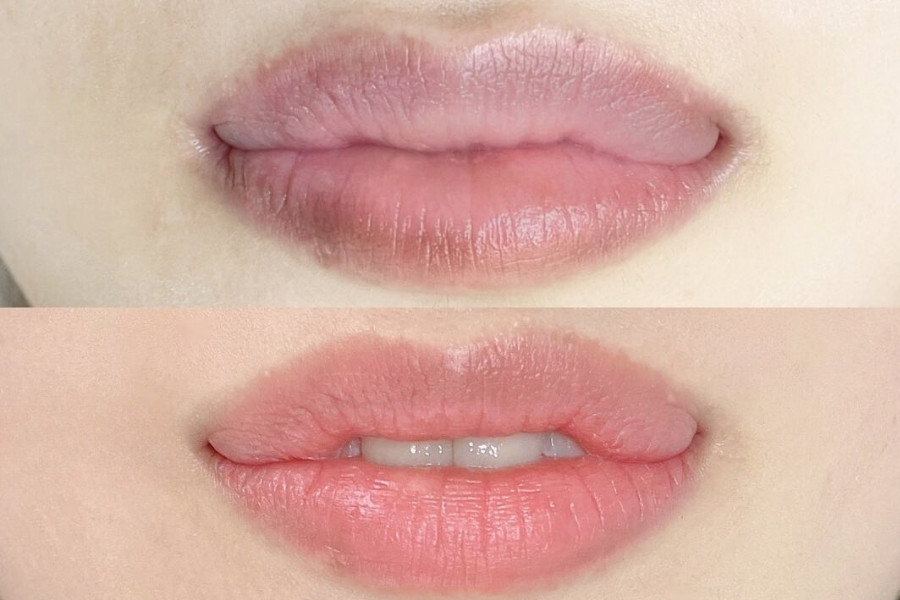 điều trị môi thâm bẩm sinh bằng laser điều trị môi thâm bẩm sinh bằng laser