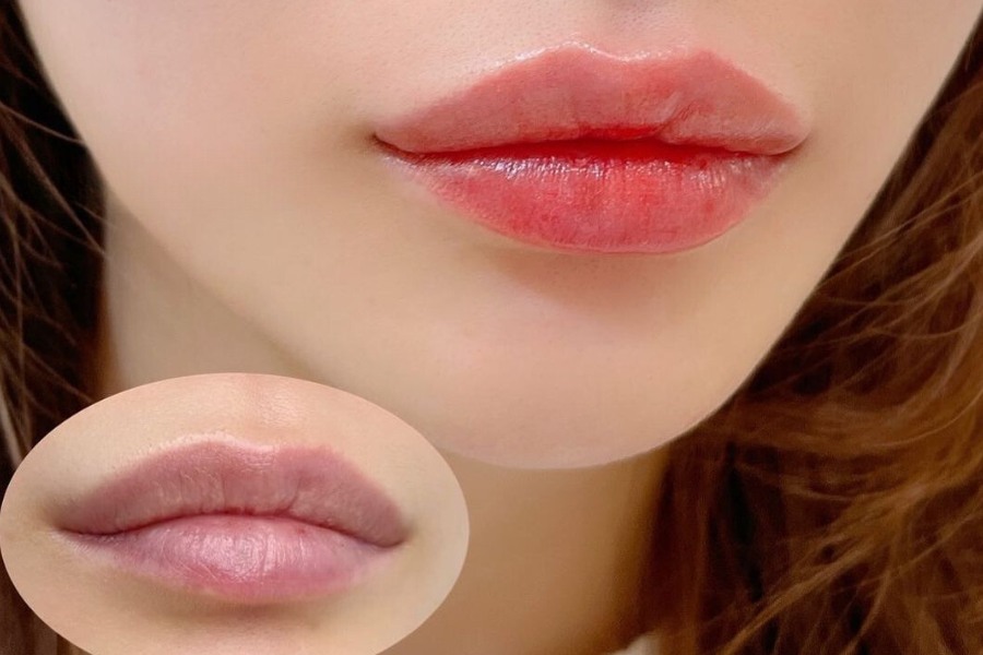 Đội ngũ kỹ thuật viên tại TMV Ngọc Dung sẽ khắc phục mọi khuyết điểm, môi thâm bẩm sinh