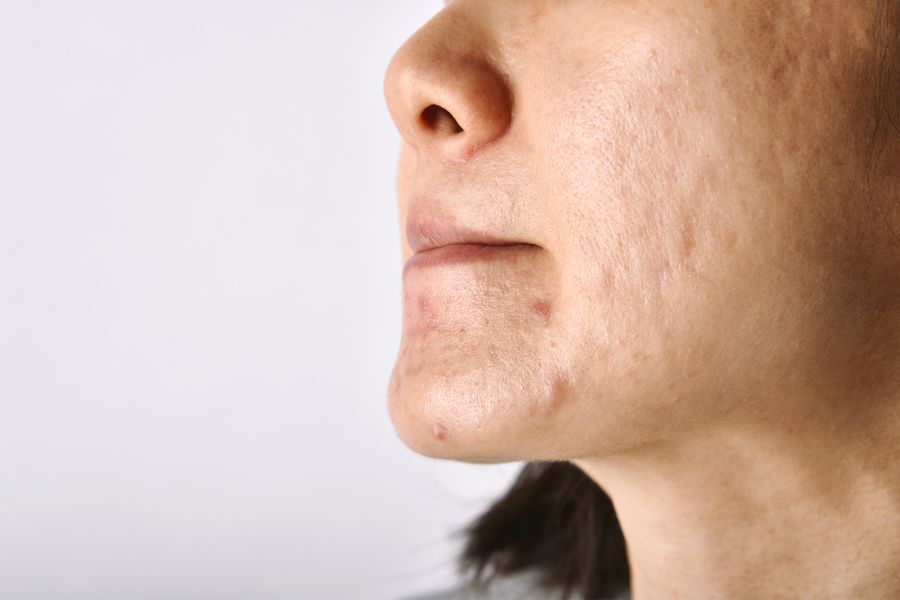 dung dau mu u tri mun