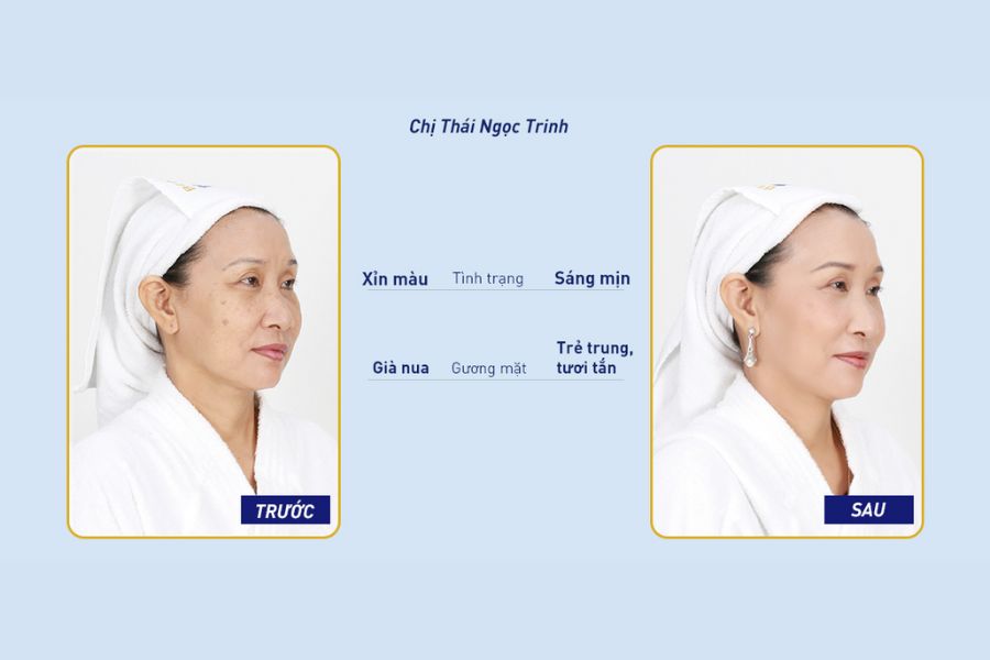 Hình ảnh khách hàng điều trị nám tại Ngọc Dung Beauty Hình ảnh khách hàng điều trị nám tại Ngọc Dung Beauty