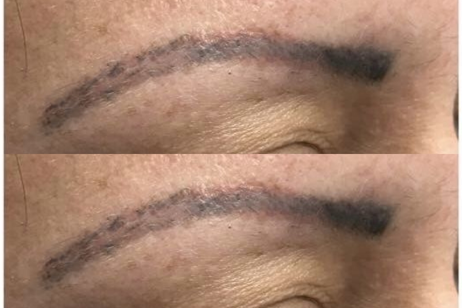 Hình ảnh xăm lông mày hỏng, bong tróc và mực phai màu nhanh