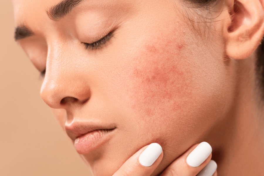 Có nên bôi kem chống nắng ban đêm hay không? Không nên bôi vì dễ gây nổi mụn Không nên bôi vì dễ gây nổi mụn