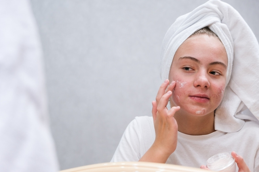 Các sản phẩm retinoid dưới dạng kem hoặc thuốc mỡ thường được sử dụng phổ biến trong quá trình điều trị mụn Vitamin A hỗ trợ điều trị mụn