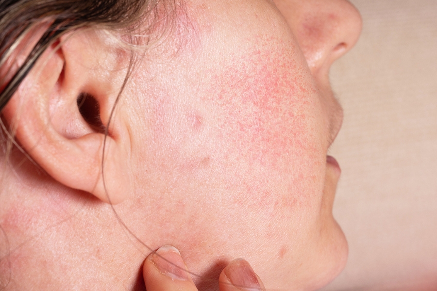 Xông hơi mặt bằng lá tía tô giúp ngừa viêm, giảm kích ứng